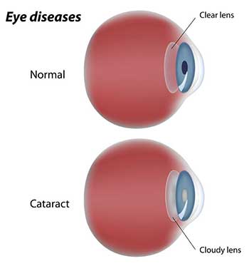 cataracts