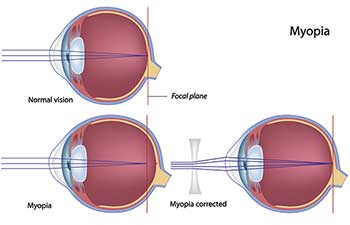 nearsightedness